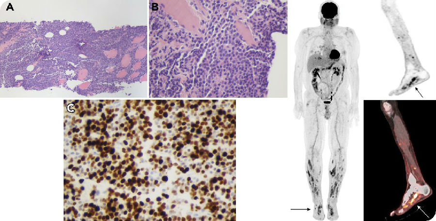 多次复发、累及部位罕见的骨髓瘤一例