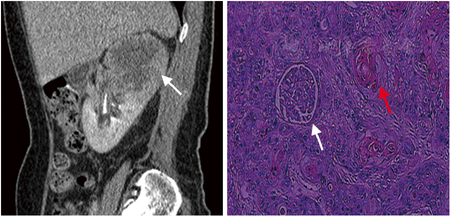 原发性肾鳞状细胞癌一例